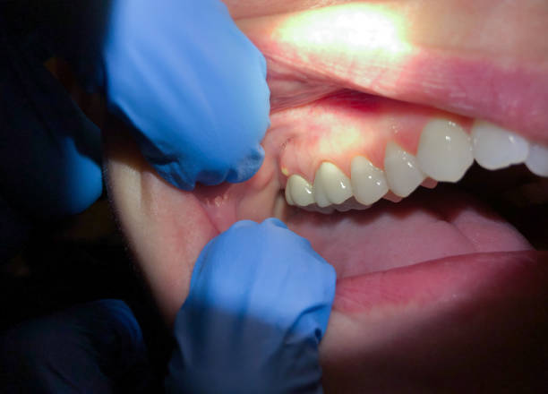 Best Emergency Wisdom Teeth Removal in Rhinelander, WI
